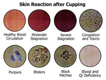 Six Reactions After Cupping | Fighting Arts Health Lab