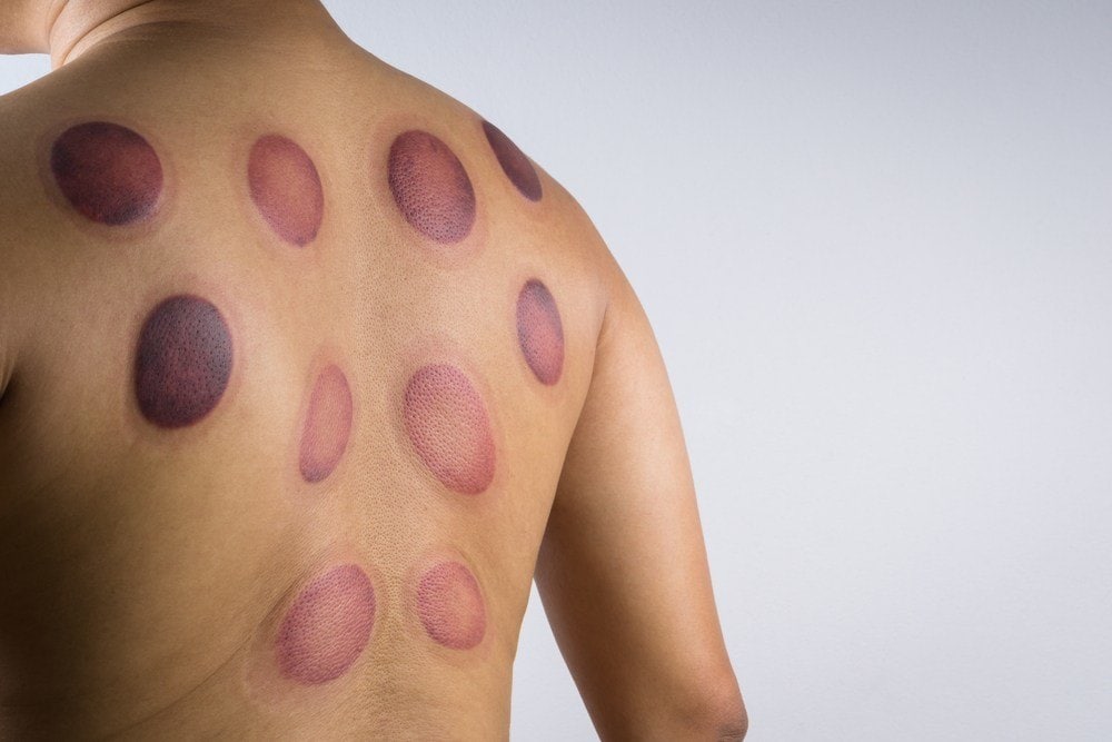 Cupping Therapy | Fighting Arts Health Lab