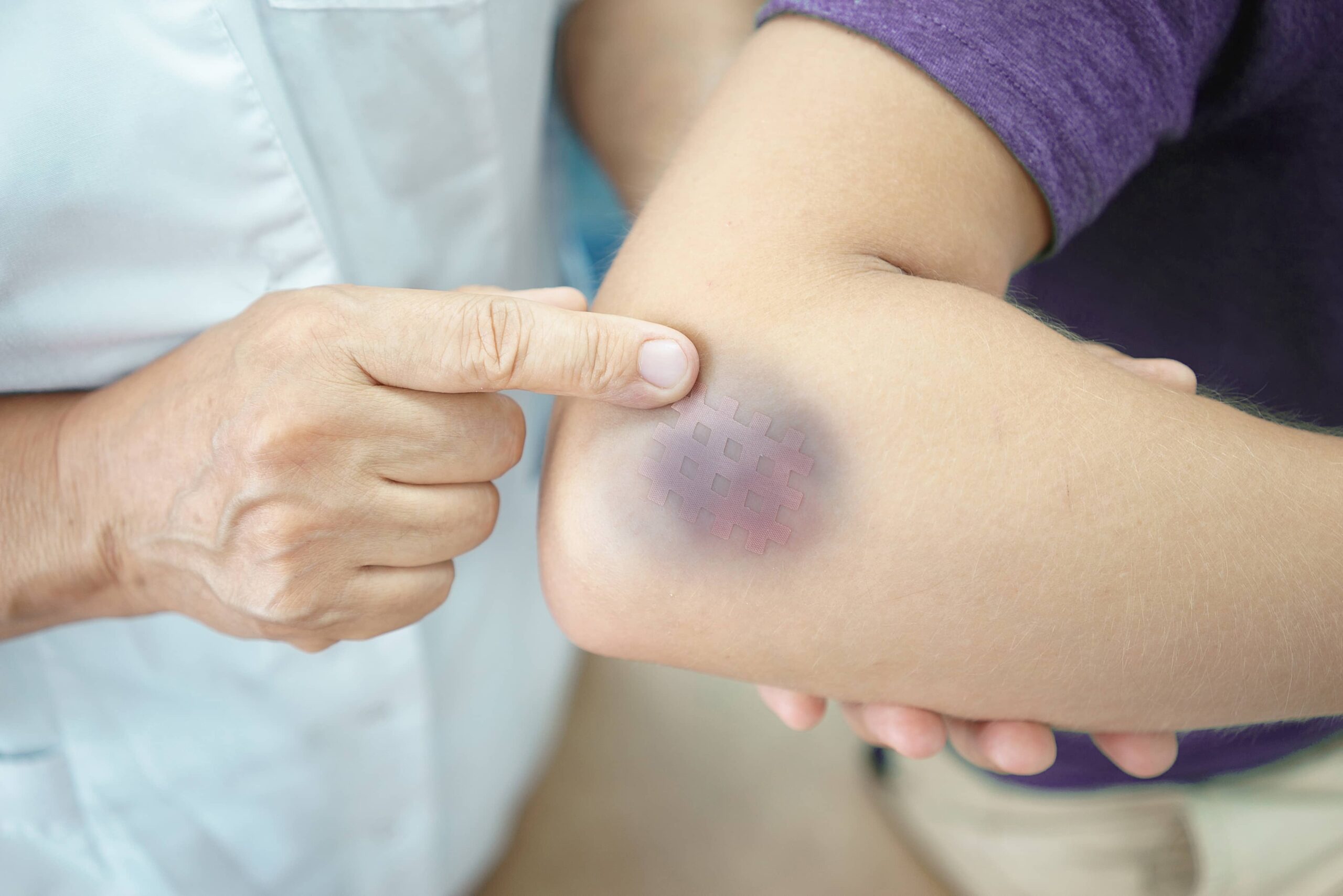 Elbow Bruise Diagnosis