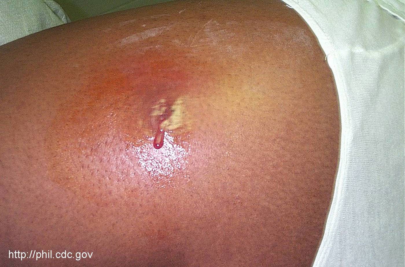 Staph Infection Abscess